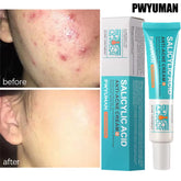 Salicylic Acid Acne Treatment Cream for Pore Cleansing, Redness Reduction, and Moisturizing Skin Care