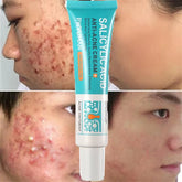 Salicylic Acid Acne Treatment Cream for Pore Cleansing, Redness Reduction, and Moisturizing Skin Care