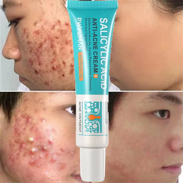 Salicylic Acid Acne Treatment Cream for Pore Cleansing, Redness Reduction, and Moisturizing Skin Care