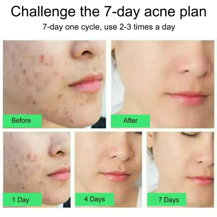 Salicylic Acid Acne Treatment Cream for Pore Cleansing, Redness Reduction, and Moisturizing Skin Care