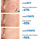 Salicylic Acid Acne Treatment Cream for Pore Cleansing, Redness Reduction, and Moisturizing Skin Care
