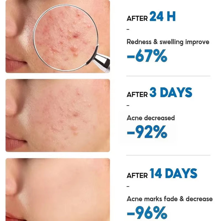 Salicylic Acid Acne Treatment Cream for Pore Cleansing, Redness Reduction, and Moisturizing Skin Care